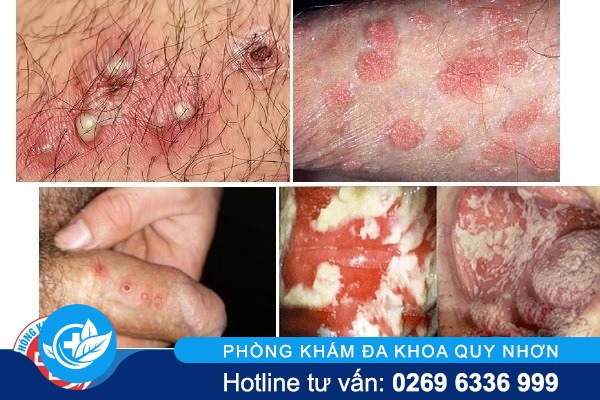 noi-hat-li-ti-vung-kin