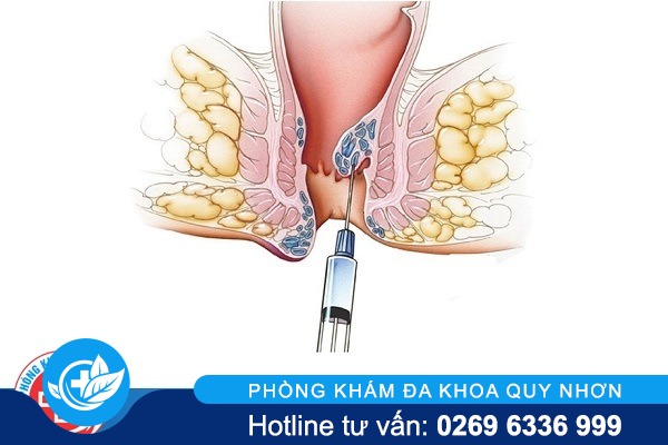 Tiêm xơ búi trĩ có hiệu quả không chi phí bao nhiêu?