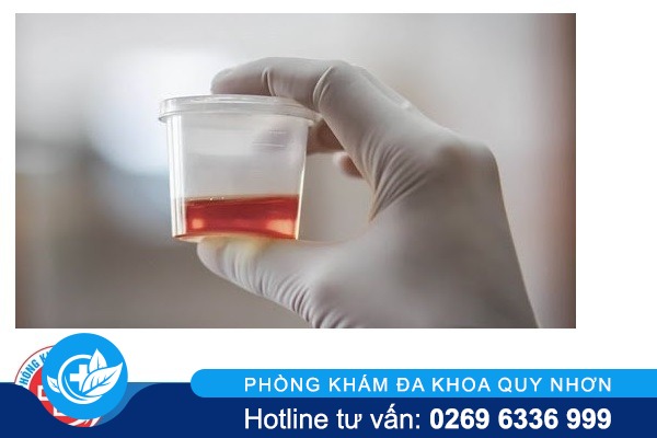 Chữa tiểu ra máu bằng cách nào hiệu quả?