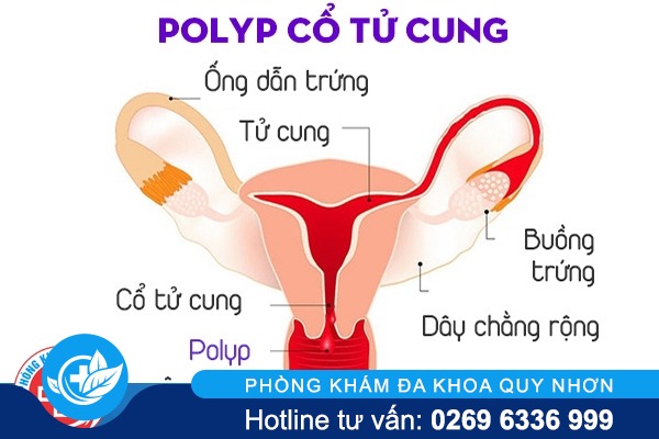 Polyp cổ tử cung là căn bệnh như thế nào và những điều cần chú ý