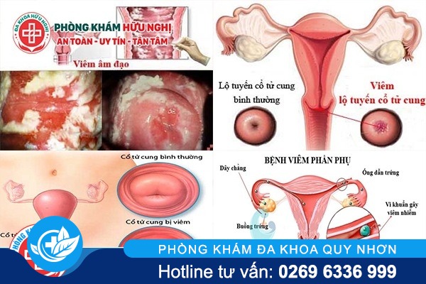 cac-benh-gay-viem-ngua-phu-khoa