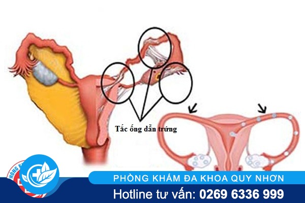 Tắc ống dẫn trứng điều trị như thế nào ?