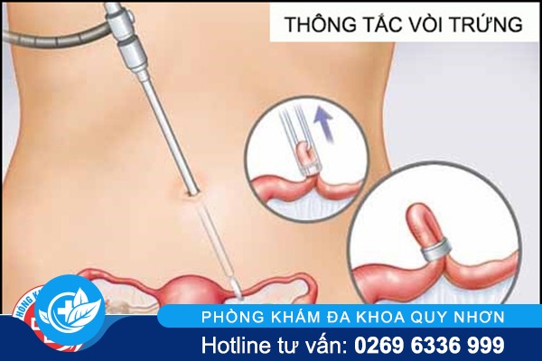 Thông tắc vòi trứng an toàn
