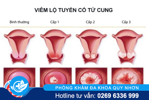 viem-lo-tuyen-co-tu-cung-cap-do-2