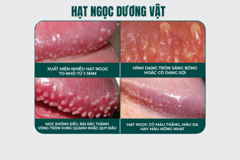 Nguyên nhân nổi hạt ngọc dương vật và cách trị hiệu quả
