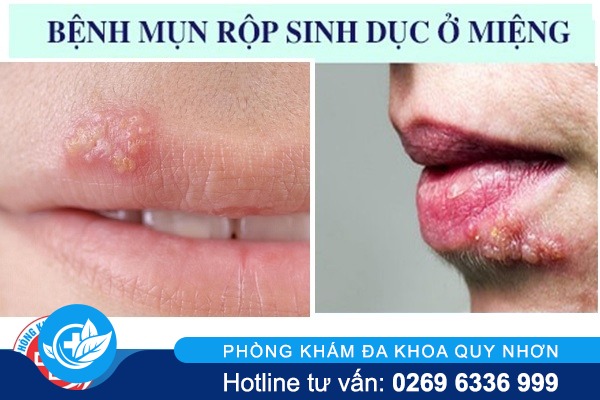 benh-mun-rop-sinh-duc-o-mieng