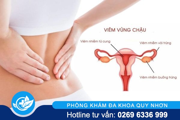Cách trị viêm vùng chậu hiệu quả