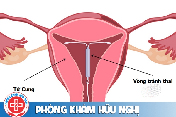Đặt vòng tránh thai sau phá thai có được không?