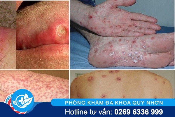 dau-hieu-giang-mai-the-nao