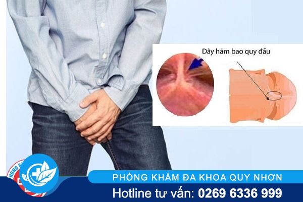 Đứt dây hãm dương vật nguy hiểm không?
