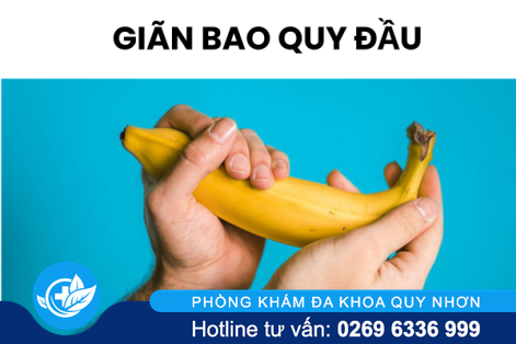 Giãn bao quy đầu là bị bệnh gì?