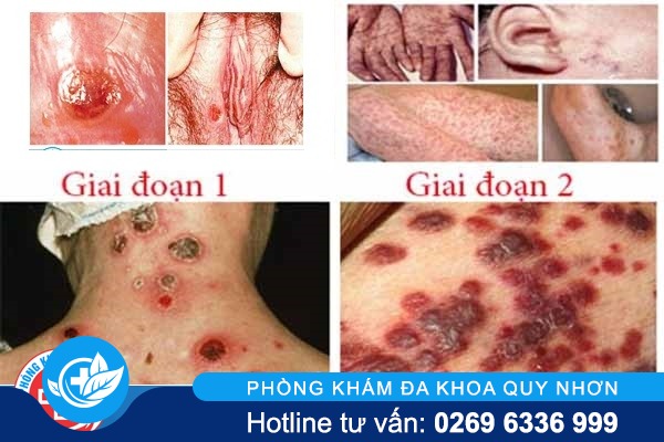 giang-mai-nu-dau-hieu