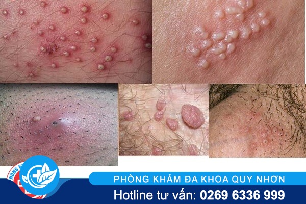 Âm đạo chảy mủ do lậu