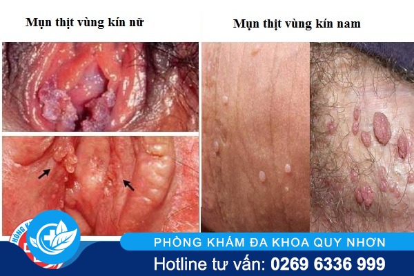 mun-thit-vung-kin-nguy-hiem