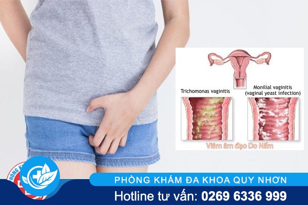 Ngứa môi lớn vùng kín nữ nguyên nhân và cách điều trị