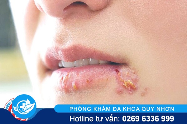 Nổi mụn ở miệng là bị bệnh gì?