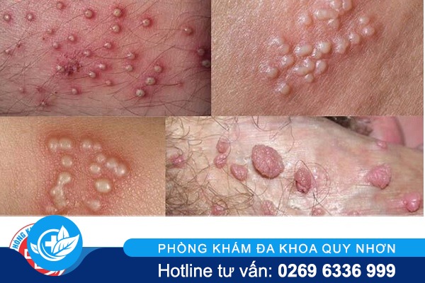 Âm đạo chảy mủ do lậu