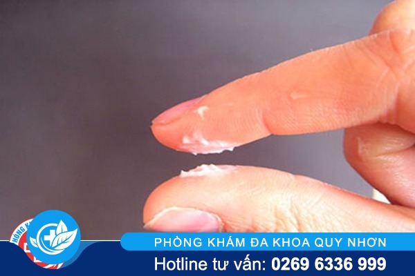 Vùng kín có mảng trắng là bị bệnh gì?