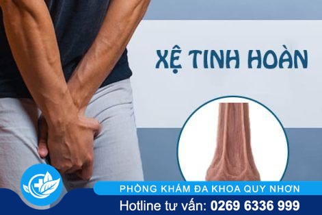 Nguyên nhân gây xệ tinh hoàn và cách điều trị