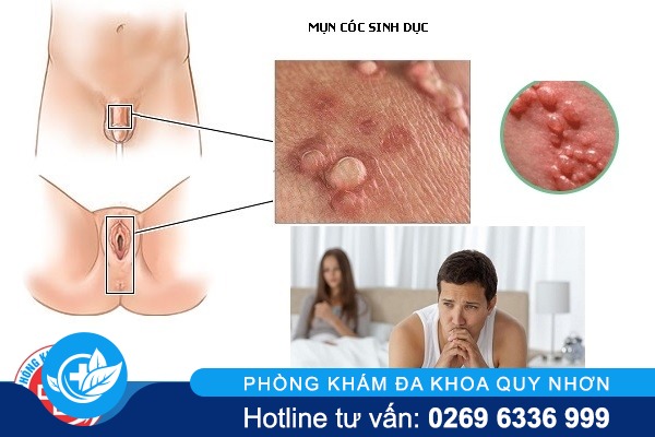 xet-nghiem-mun-coc-sinh-duc