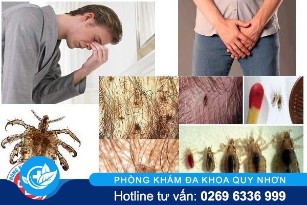 Bệnh rận mu cách chữa trị hiệu quả nhất