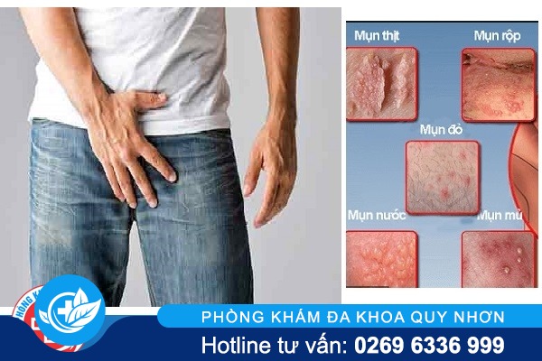 Nổi mụn ở háng dấu hiệu bị bệnh gì?