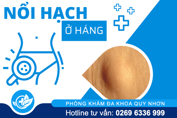 Giải đáp hiện tượng nổi hạch ở háng