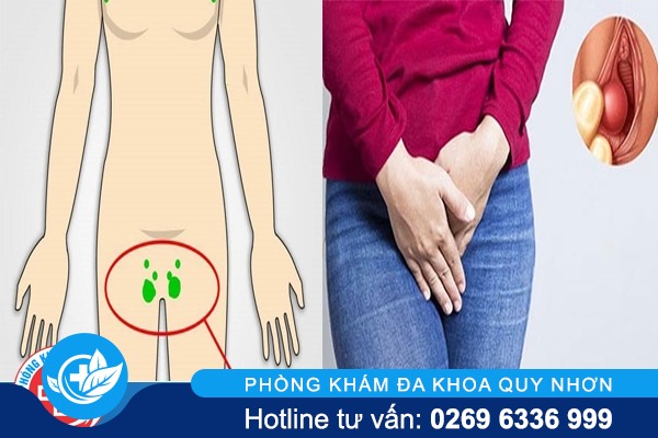 Nguyên nhân nổi hạch ở vùng kín nam nữ