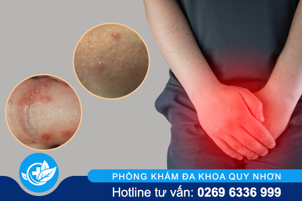 Các Phương Pháp Điều Trị Viêm Bao Quy Đầu Hiện Nay