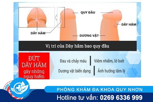 Đứt dây hãm bao quy đầu: cẩn thận nguy hiểm!