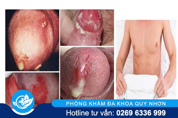 Bệnh lậu ở nam giới: triệu chứng & cách phòng ng