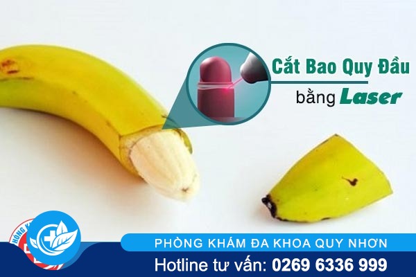 Cắt bao quy đầu bằng laser có an toàn không? quy trình như thế nào?