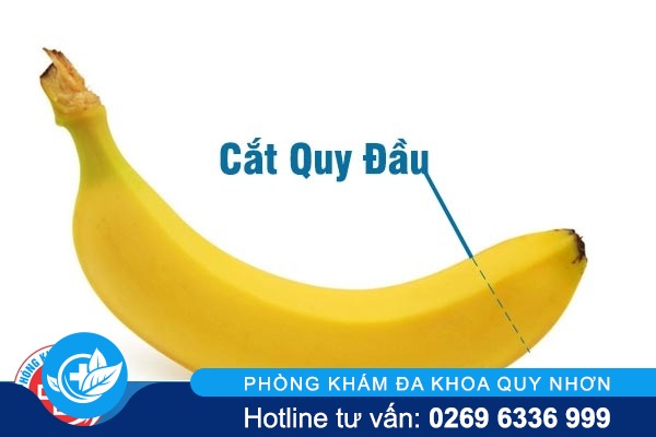 Cắt quy đầu là gì? có nên thực hiện không?
