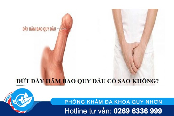 Đứt dây chằng dương vật nguyên nhân và cách điều trị
