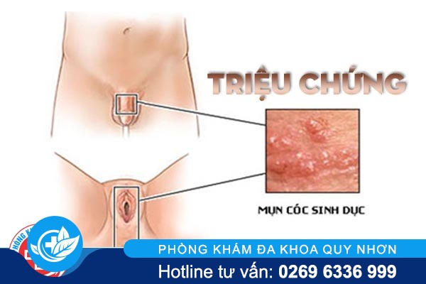 dieu-can-biet-ve-mun-coc-sinh-duc-2