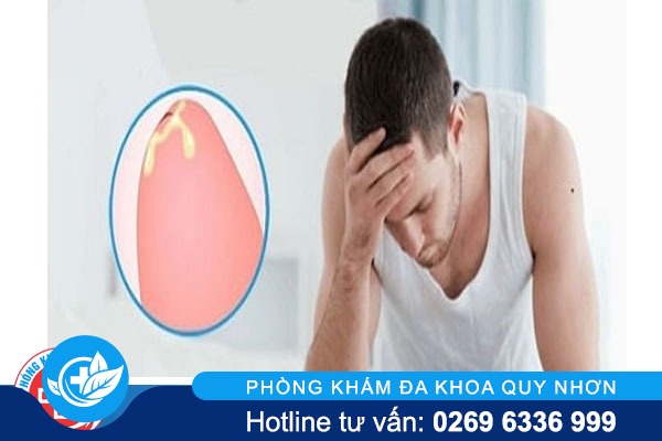 Dương vật chảy dịch bất thường là bệnh gì?