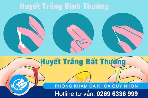 huyet-trang-nhung-luu-y-khong-nen-bo-qua-1
