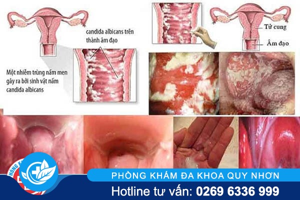 Nấm candida nguyên nhân, triệu chứng và cách khắc phục hiệu quả