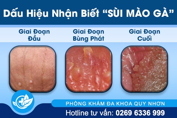 Nhận biết sùi mào gà qua các giai đoạn