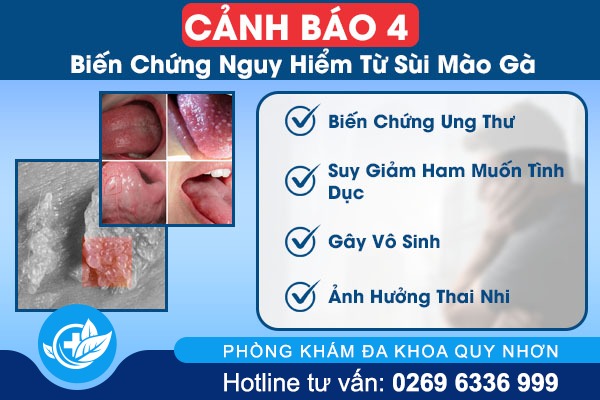 4 biến chứng nguy hiểm từ bệnh sùi mào gà
