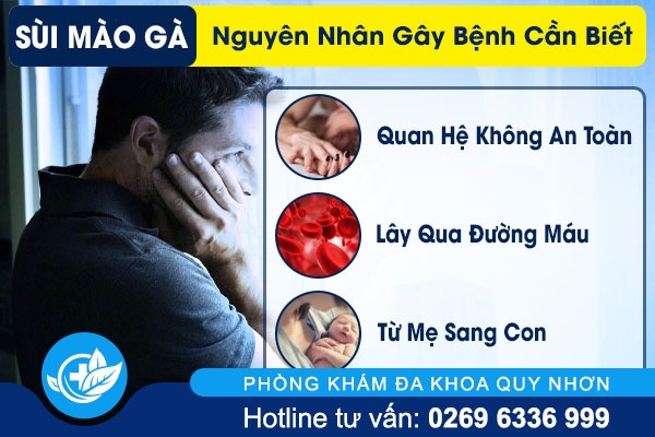Sùi mào gà và nguyên nhân gây bệnh cần biết