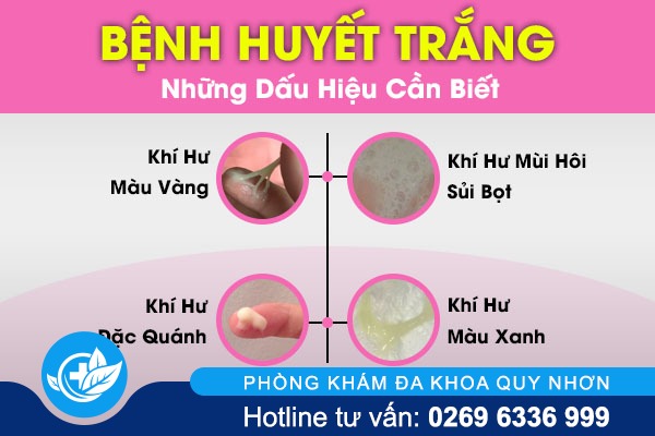 Tổng quan thông tin về bệnh huyết trắng