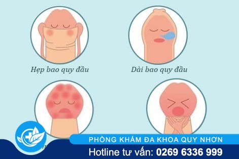 Giá cắt bao quy đầu hiện nay khoảng bao nhiêu và nên cắt ở đâu?