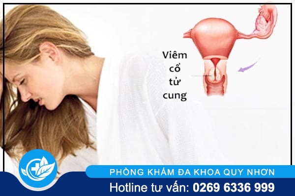 Viêm cổ tử cung là gì? và những điều cần lưu ý