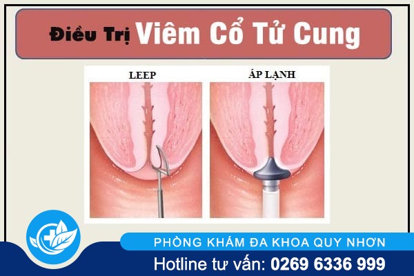 viem-co-tu-cung-la-gi-va-nhung-dieu-can-luu-y-5