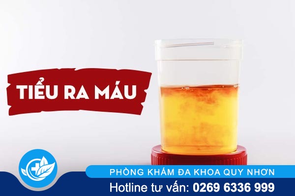 Tiểu ra máu – Tiềm ẩn nhiều nguy hiểm khôn lường