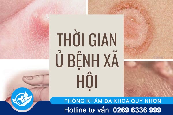 xac-dinh-thoi-gian-u-benh-xa-hoi-1