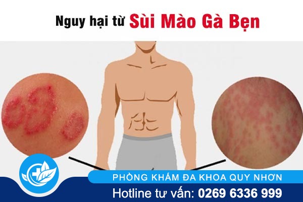 nhung-su-that-ve-can-benh-sui-mao-ga-ben-2