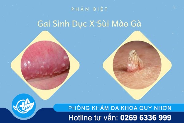 Phân biệt nhanh gai sinh dục và sùi mào gà 
