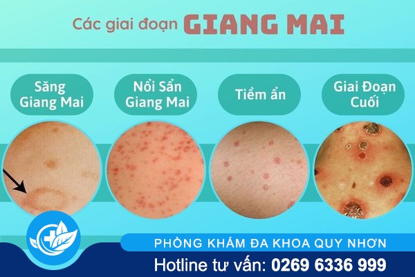 cac-thong-tin-can-biet-ve-giang-mai-2